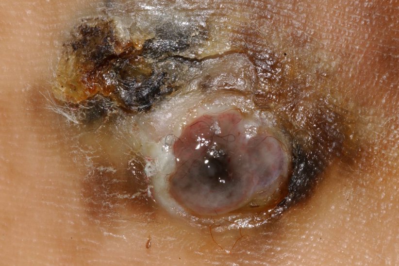 Imagine a melanomului lentiginos acral.