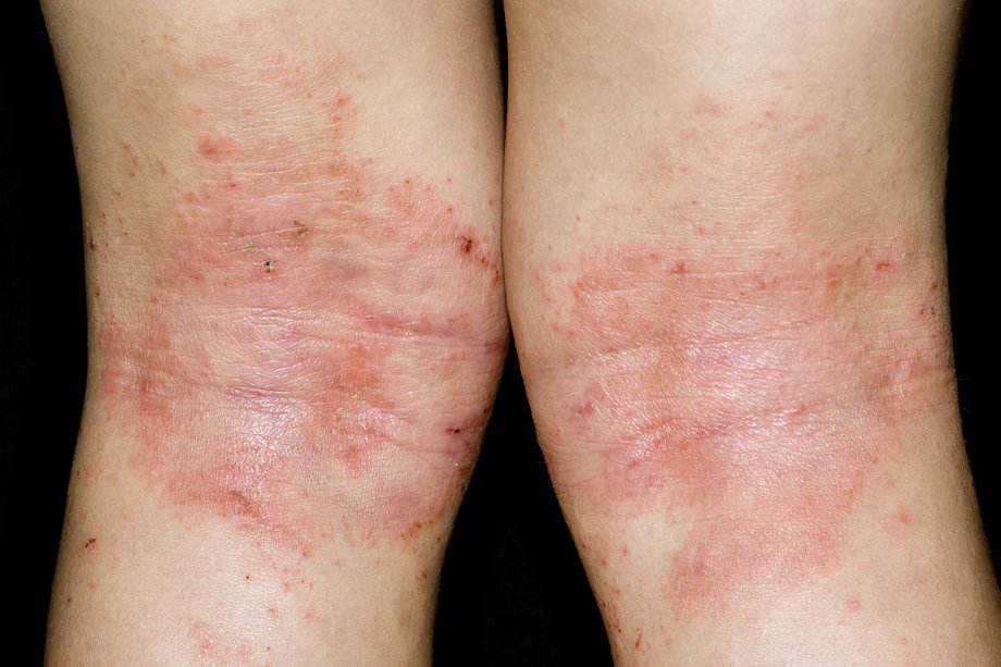 Eczema pe genunchi
