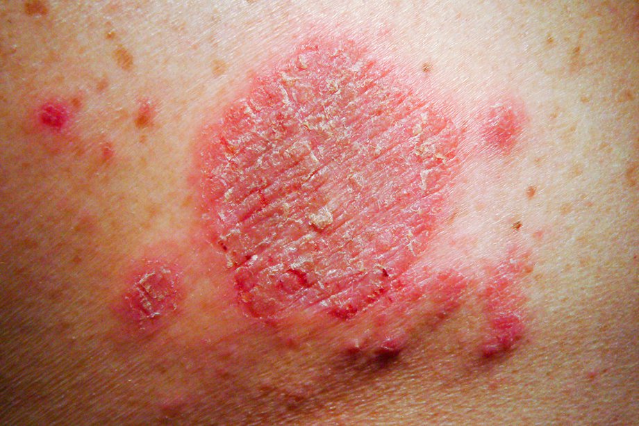 Imagine cu eczeme discoide
