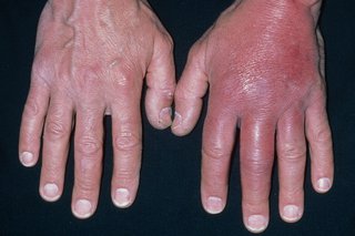 Mâinile umflate cauzate de celulită