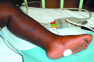 Imagine cu erupții cu meningită pe picior și picior de copil cu piele întunecată