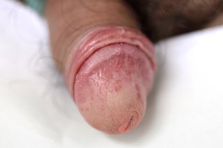 Un penis cu pielea roșie, iritată
