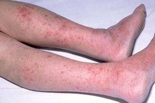 Imagine cu erupții cu meningită pe picioare și picioare ale unui copil cu pielea albă