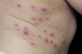 Impetigo blistere pe torsul unui copil mic