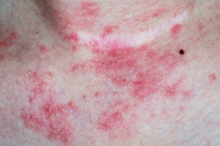 Eczeme atopice erupții roșii netede pe piept și gât