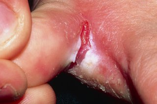 Pielea crăpată între degetele cauzate de piciorul unui atlet