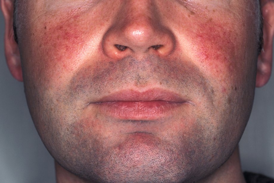 Imagine de roșeață facială cauzată de rozacee