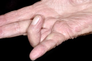 Mâna dreaptă albă întinsă cu degetul inelar îndoit spre palmă