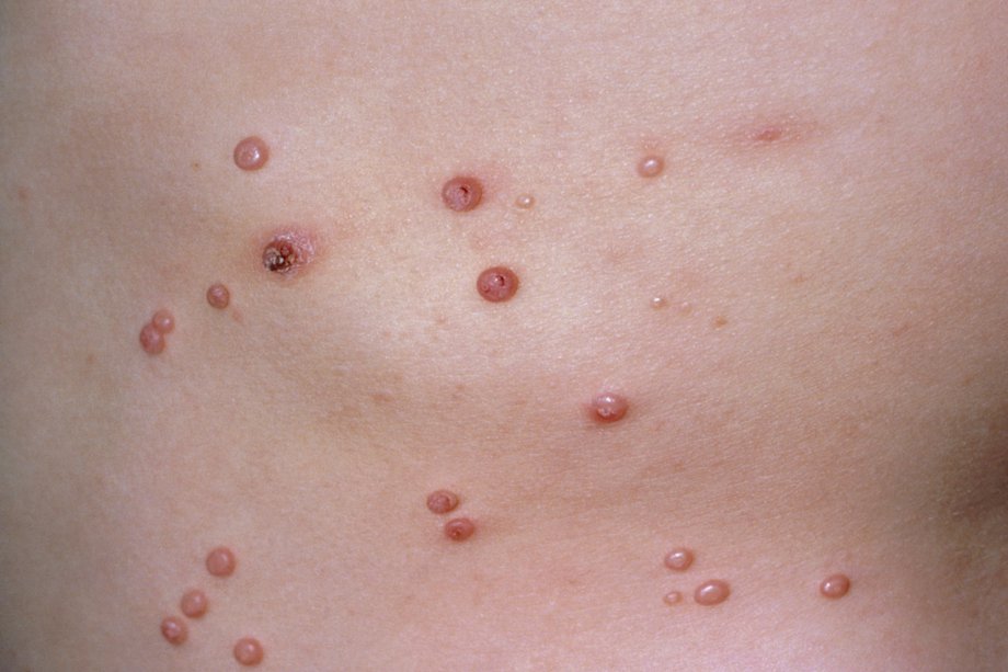 Imagine cu erupții cutanate cu molluscum contagiosum