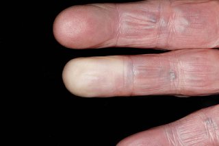Degete albe cauzate de Raynaud