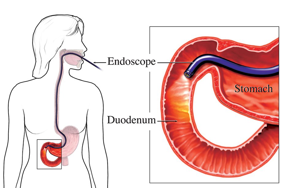 Diagrama care prezintă o endoscopie