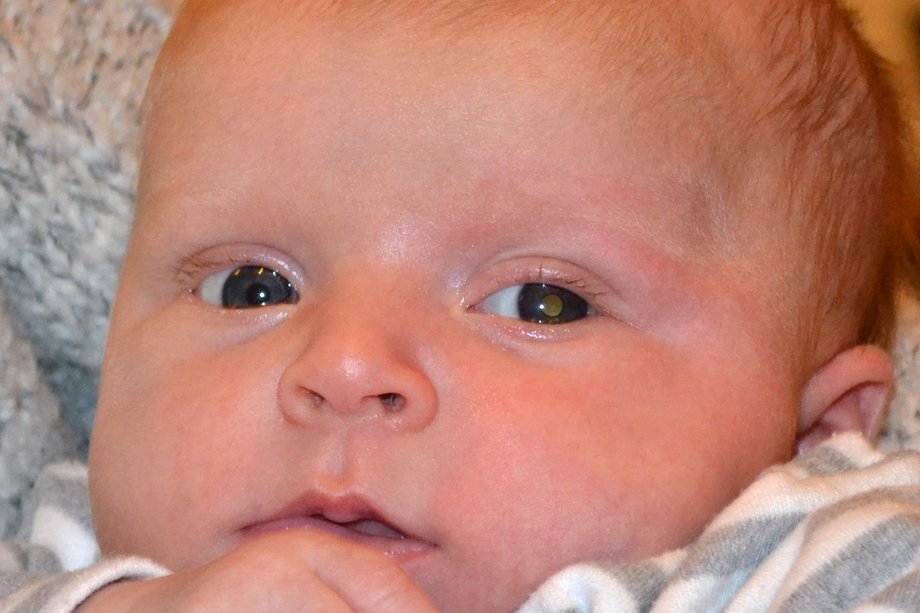 Un prim-plan al feței unui bebeluș care arată reflectarea albă caracteristică în pupila ochiului