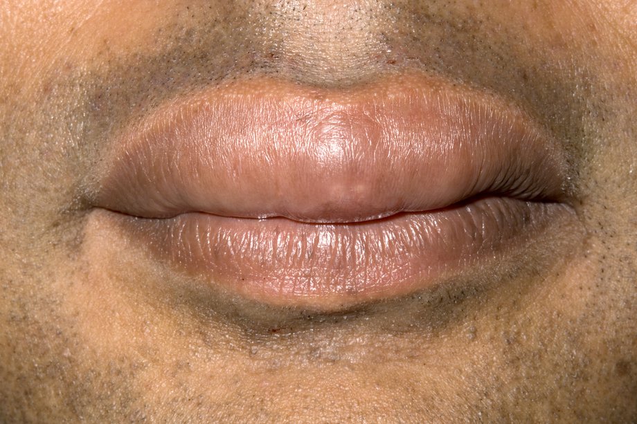 Imagine cu buzele umflate cauzate de angioedem