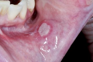 Ulcer bucal unic pe interiorul buzei de jos