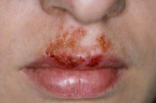 Impetigo maroniu deschis se umflă între gură și nas