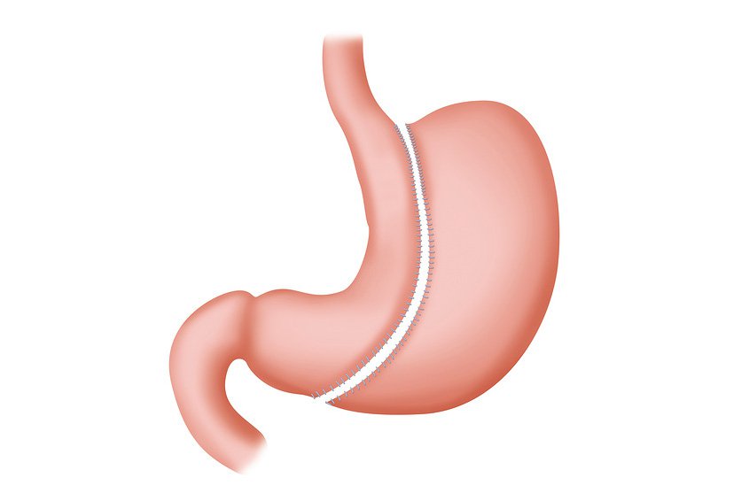 O ilustrație a unei gastrectomii cu mânecă