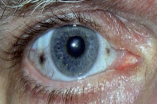 Ochi afectat de alcaptonurie, cu două pete maronii pe albul ochiului