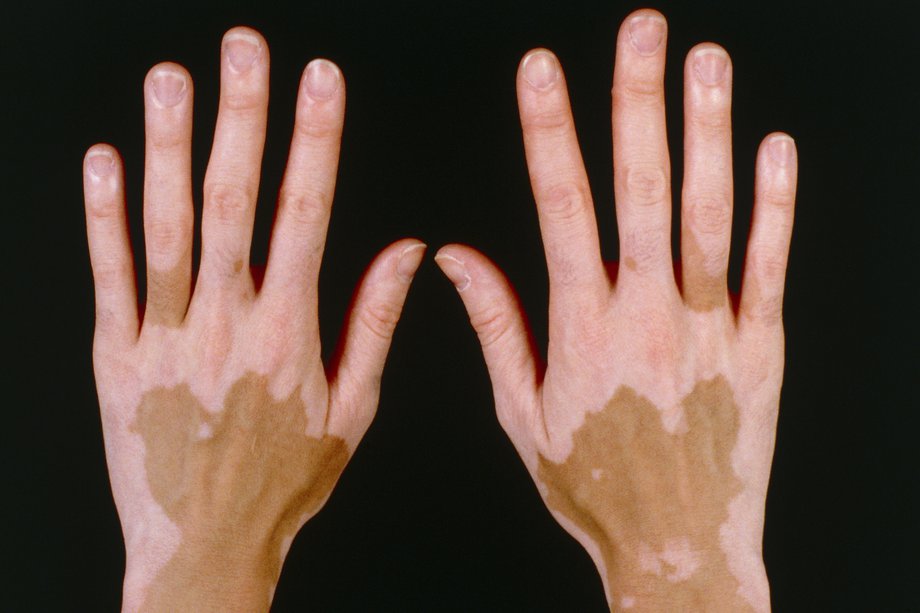Imagine cu vitiligo nes segmental pe pielea brună