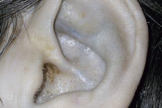 Aar afectat de alcaptonurie, cu decolorarea cartilajului galben și albastru-negru
