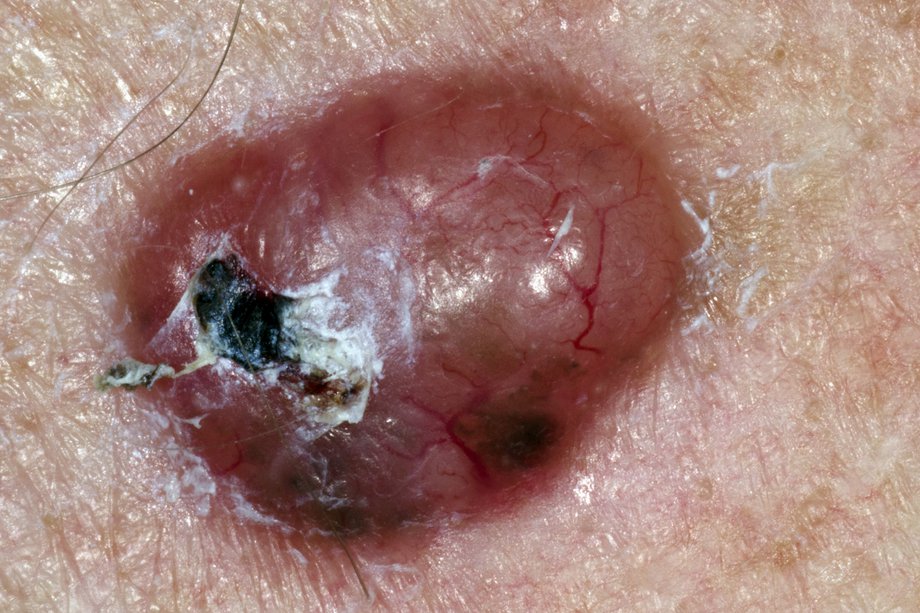 Imagine cu cancer de piele non-melanom
