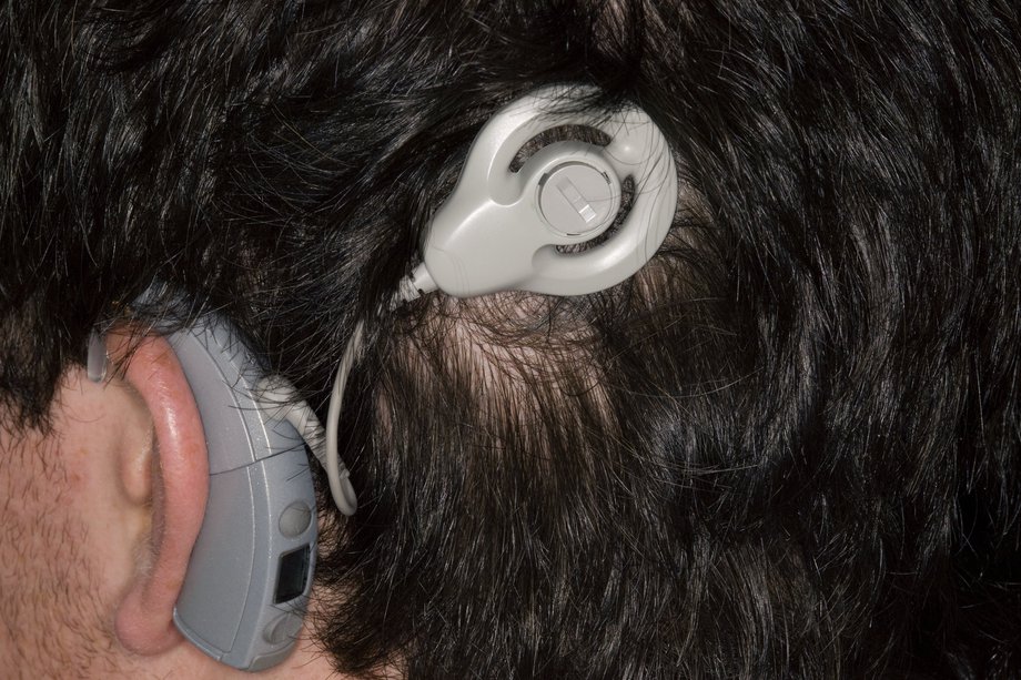 Imagine a implantului auditiv al trunchiului cerebral