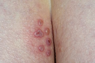 Herpes bălăceală și răni deschise (ulcere) pe fese