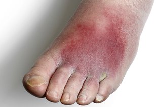 Un picior afectat de celulită
