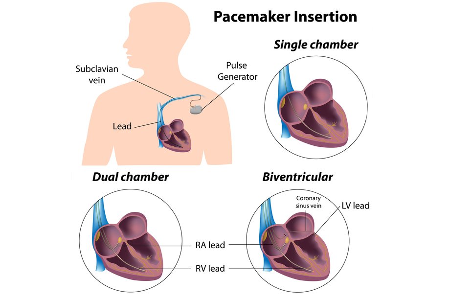 Diagrama diferitelor tipuri de stimulatoare cardiace