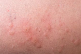 Urticaria a ridicat umflături pe piele