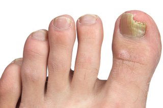 O unghie ruptă cauzată de o infecție fungică a unghiilor.