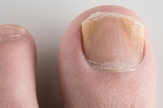 O infecție fungică a unghiilor pe marginea unei unghii.