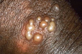 Herpes blistere pe pielea unui penis