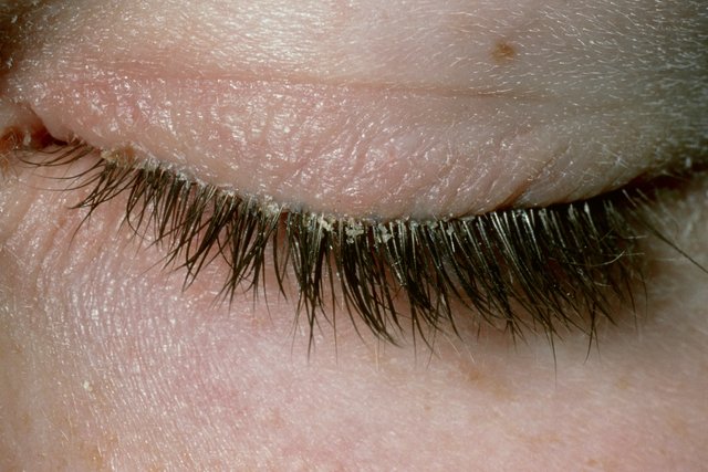 Ochi închis cu fulgi de piele și cruste de-a lungul pleoapei și genelor.