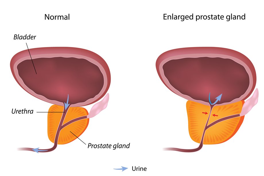 Diagrama unei prostate normale și a unei prostate mărită.
