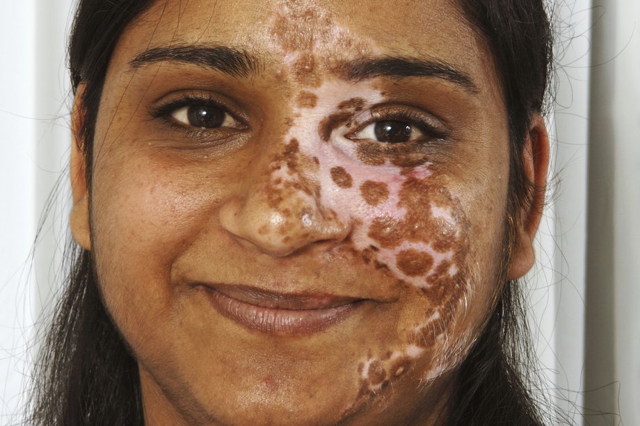 Poza unei femei cu vitiligo segmentar care afectează fața