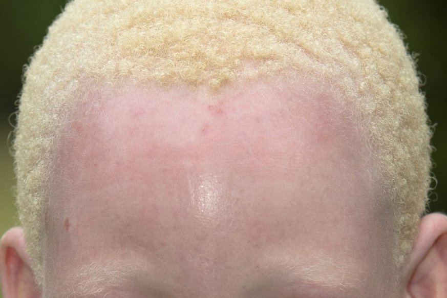 O fată africană cu albinism. Are pielea palidă și părul blond scurt și deschis.