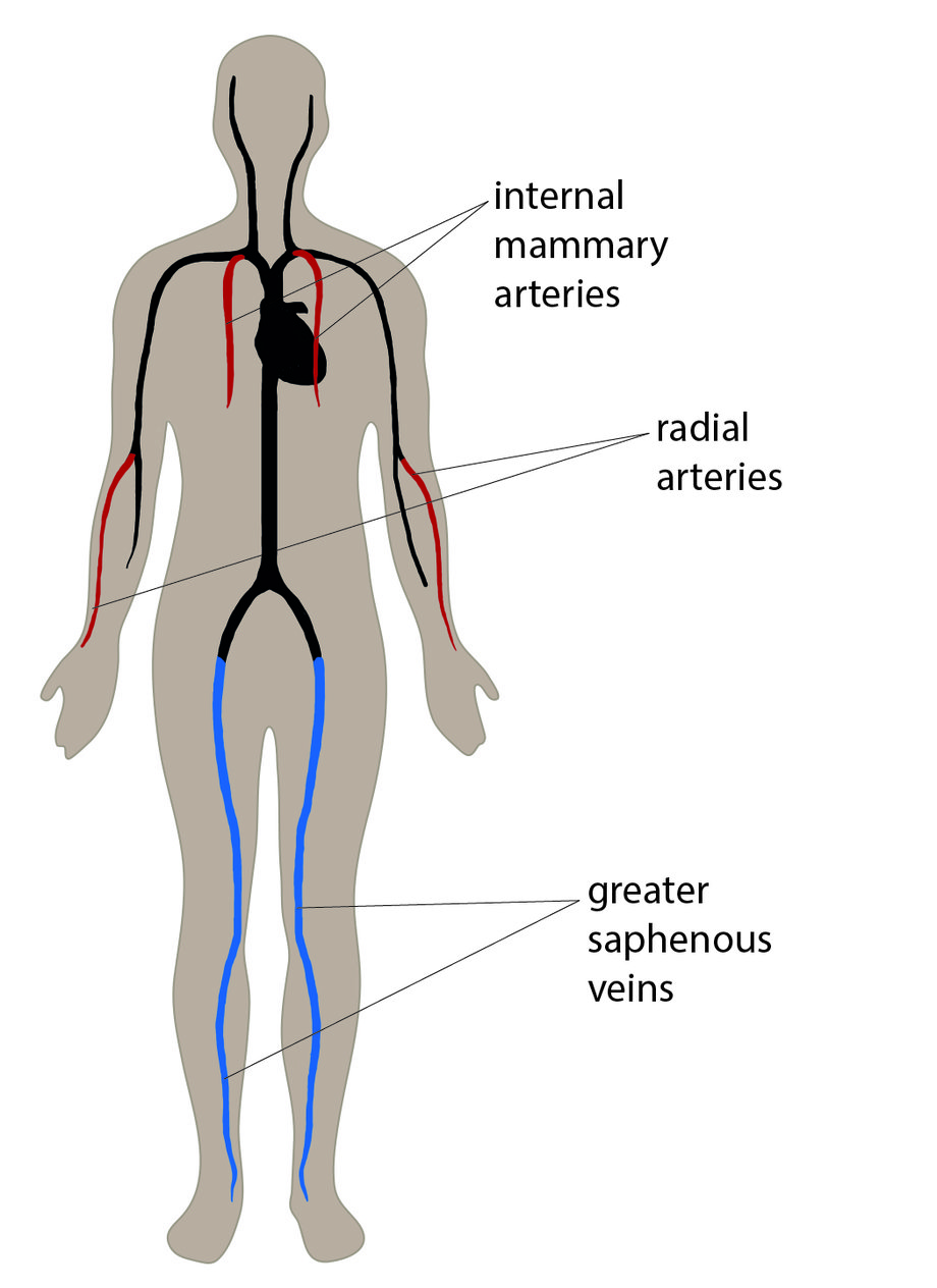 Diagrama ilustrată care arată locația arterelor mamare interne la nivelul toracelui, arterele radiale în antebrațe și vene mai safene la nivelul picioarelor