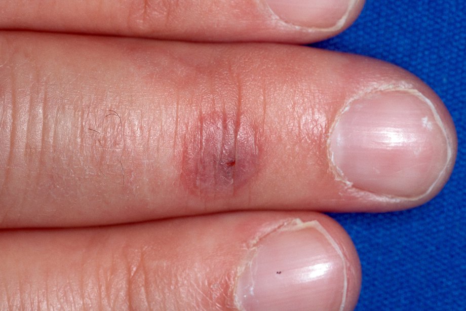 Imagine cu orf care afectează un deget