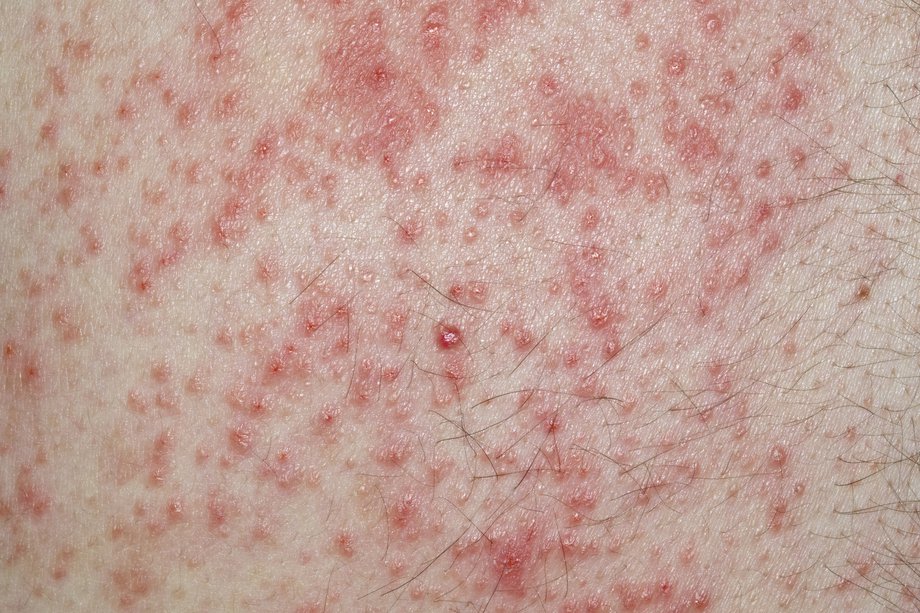 O erupție dureroasă de mici puncte roșii pe pielea albă