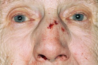 O doamnă în vârstă, cu o tăietură pe nas și cu nas