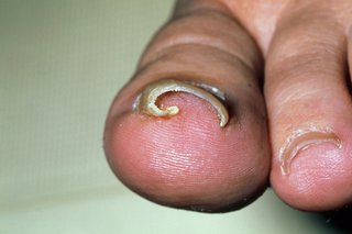 O unghie curbă în degetul mare.