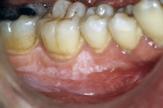 O pată albă slabă pe gingii, chiar sub dinți