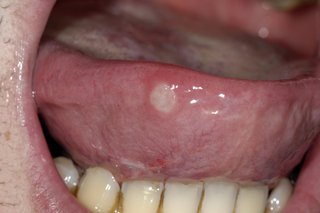 Durere rotundă albă / cenușie pe partea laterală a unei limbi care îi iese din gură