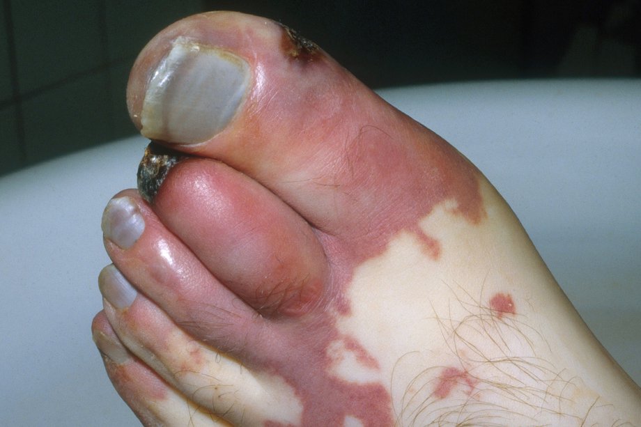 Poza unui picior afectat de gangrenă