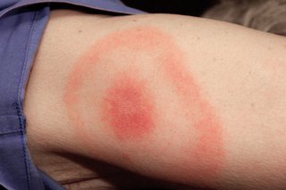 O boală Lyme clasică erupții cutanate erupții pe un braț.