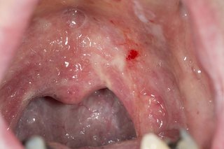 Patch-uri roșii în gură cauzate de epuizare orală