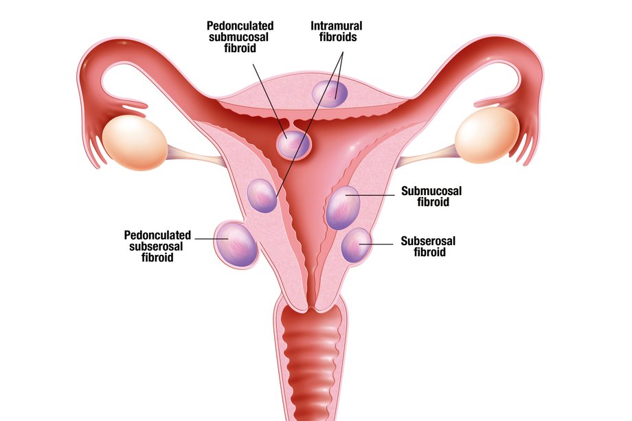 Diagrama diferitelor tipuri de fibroame