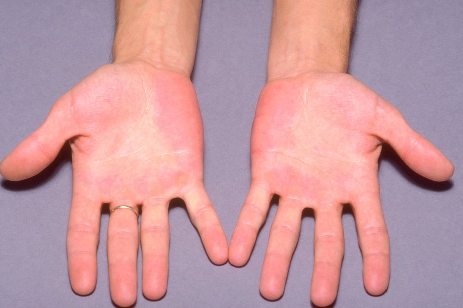 Petele roșii pe mâini cauzate de eritromelalgie.