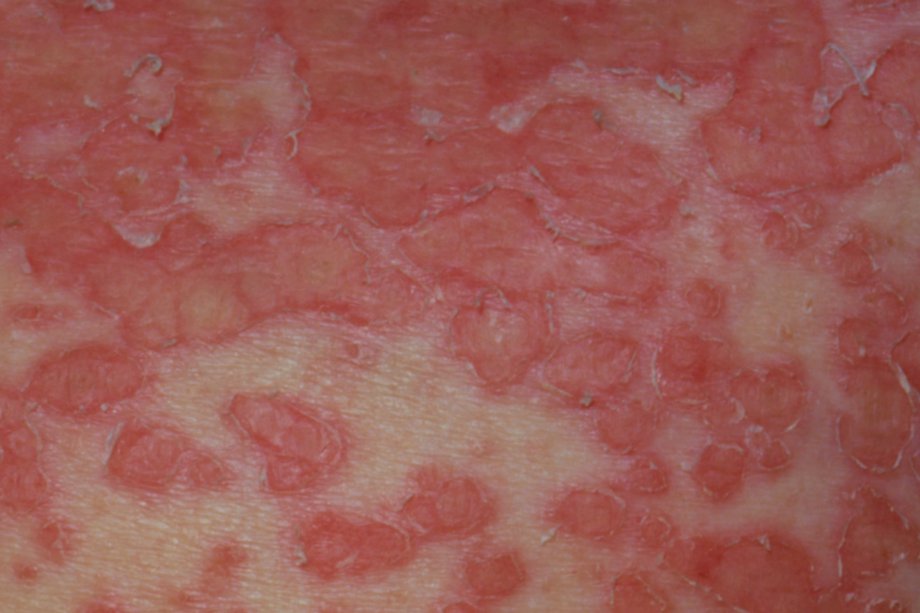 Imagine cu erupții cutanate eczema herpeticum