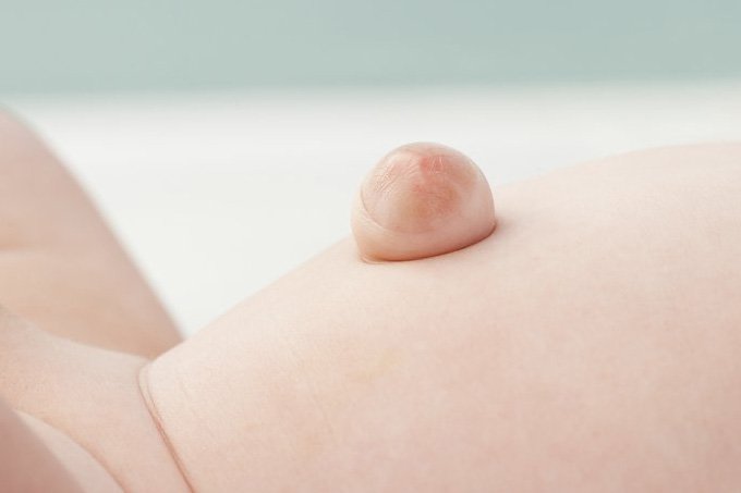 Poza unui bebeluș cu o hernie ombilicală